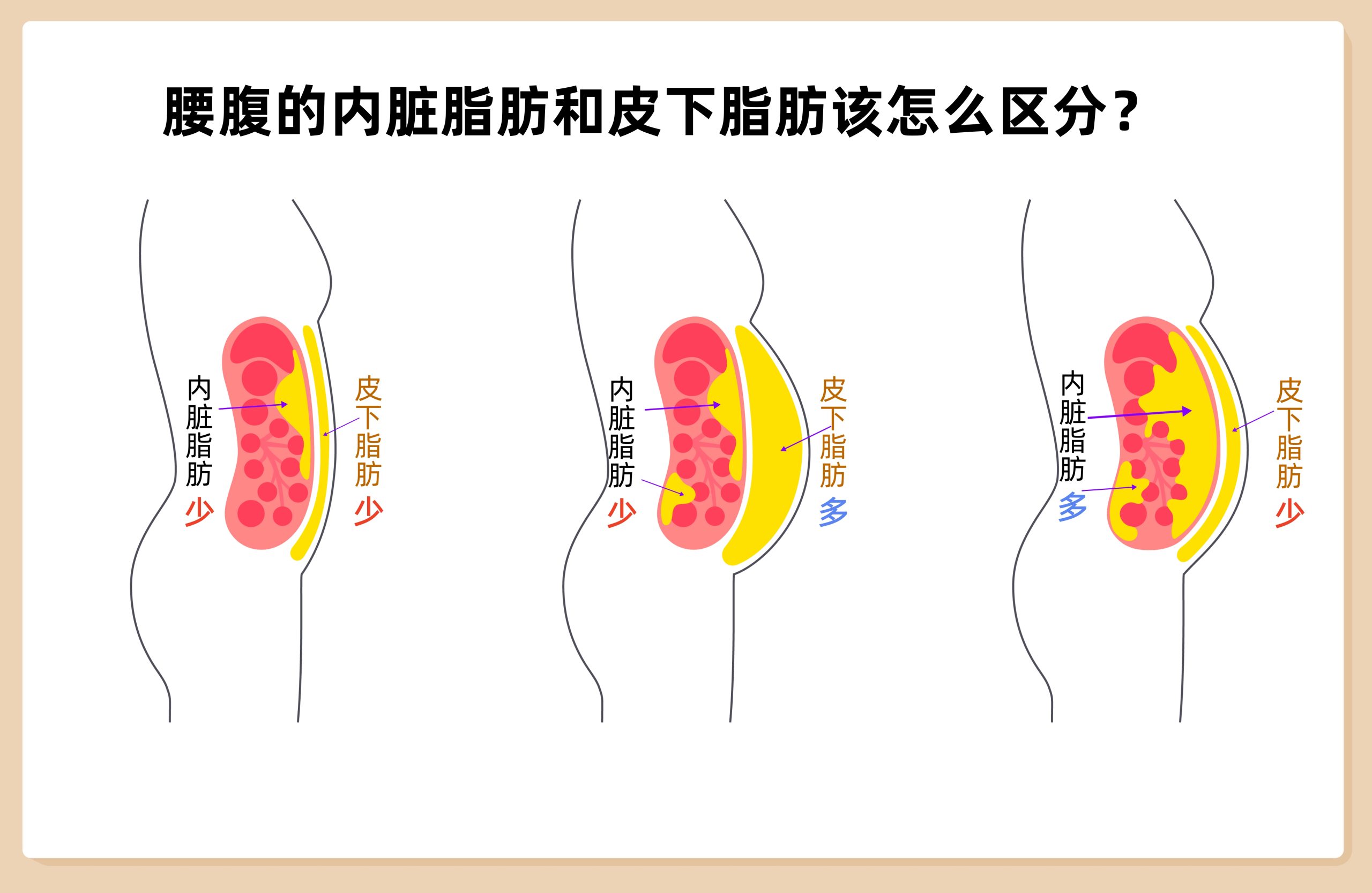 皮下与内脏脂肪对比