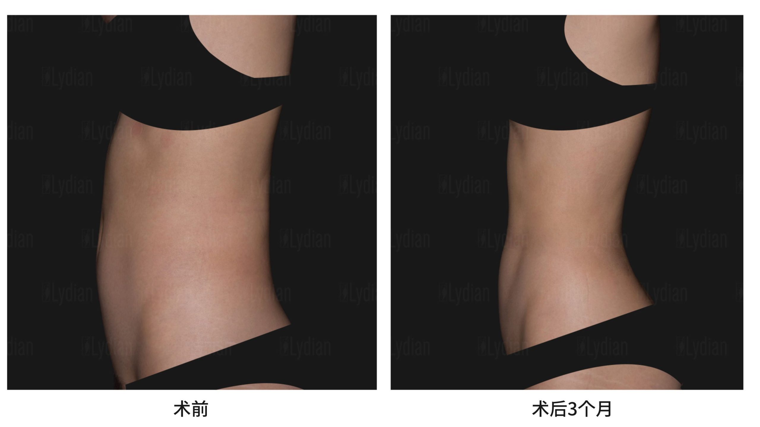 腰腹环吸完整科普