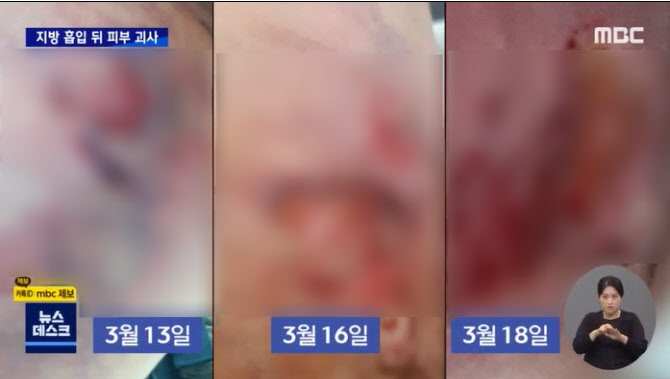 局部脂肪坏死