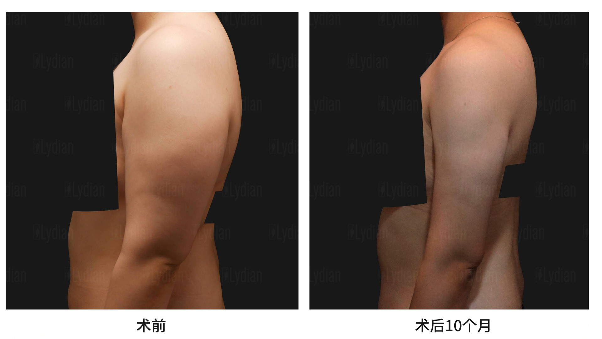 吸脂修复示意图