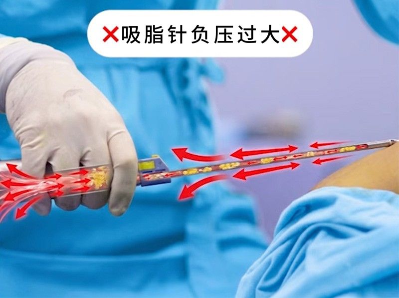 吸脂针负压