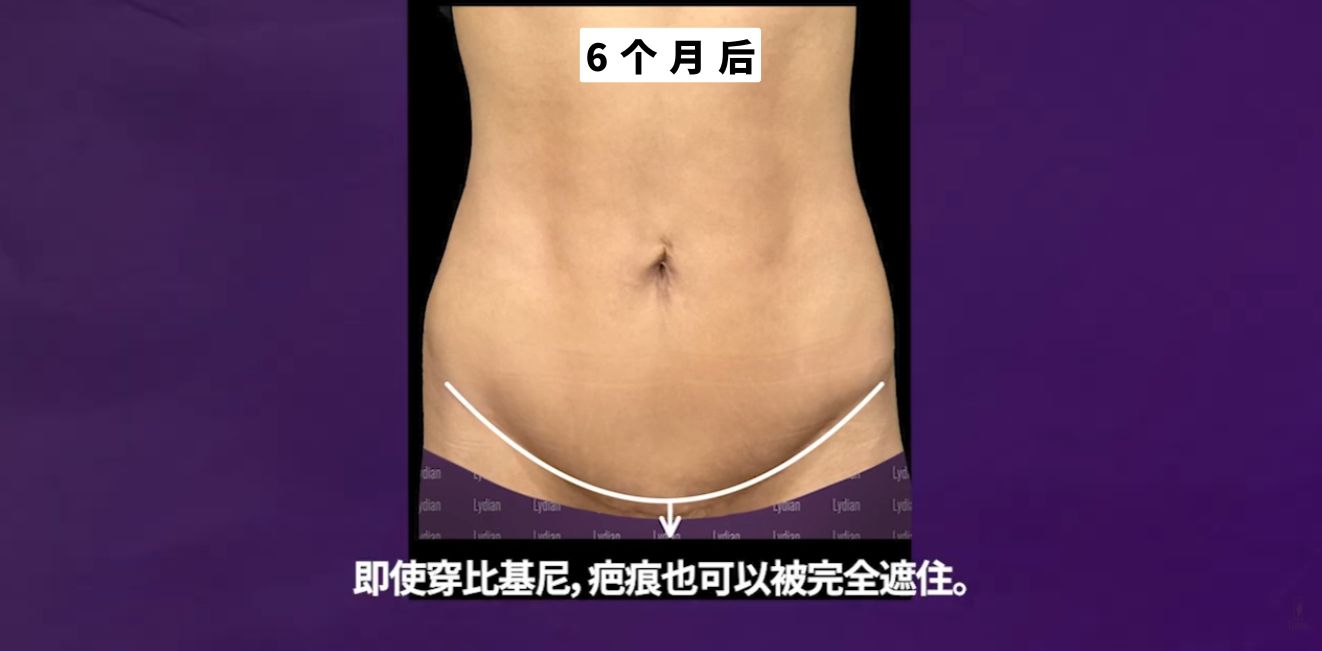 隐藏疤痕设计