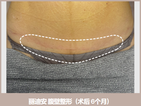 多层减张缝合