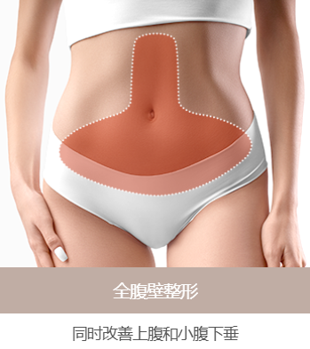 全腹壁整形术